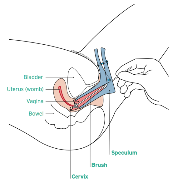 Image showing speculum insertion, with a sample of the cells of the cervix being taken by a brush. Anatomy of the female reproductive system, annotated.